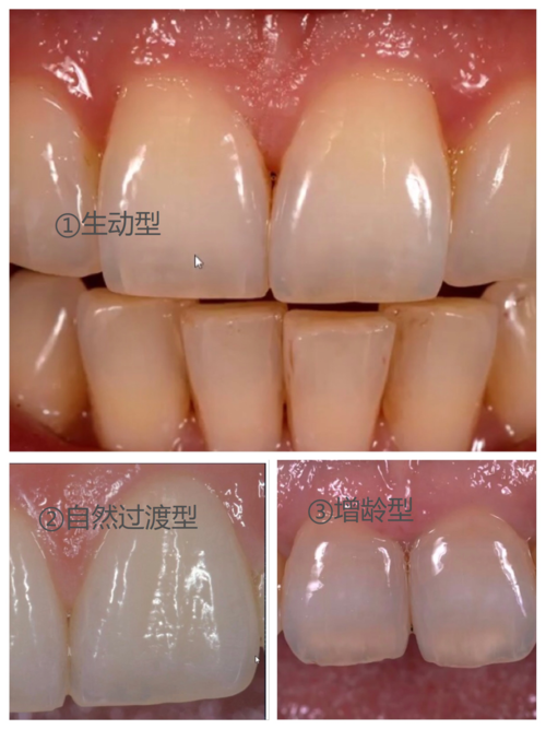 牙齿颜色中的黄金法则结构颜色