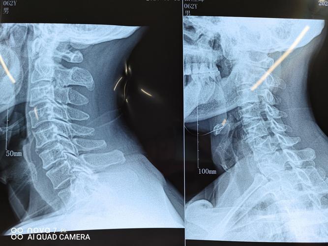 术前颈椎正侧位片,见颈椎蜕变,局部骨质增生.