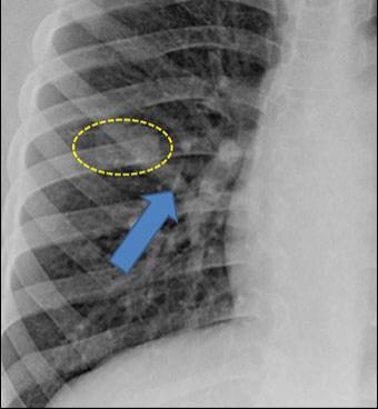 图文详解丨如何判断孤立性肺结节是良性还是恶性?