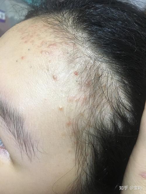 关于毛囊炎,脂溢性皮炎,痤疮的区别