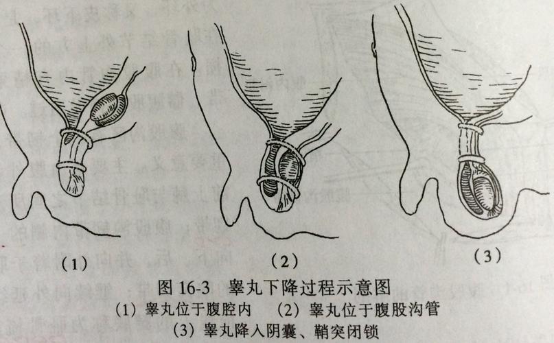 小儿腹股沟斜疝诊治的问与答