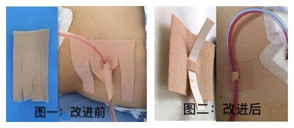 普外三科持续优化腹腔引流管固定