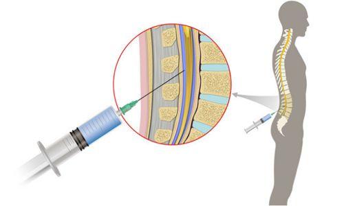 腰椎穿刺可以诊断哪些疾病?