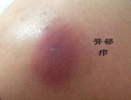 毛囊炎,疖,痈,皮脂腺囊肿怎么区分?