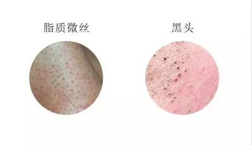 这令人崩溃的小黑头,我究竟该拿你怎么办?