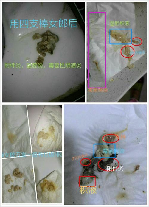 用棒女郎后的排出物对比图