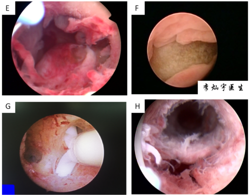 c:超声下的子宫内膜息肉d:宫腔镜下子宫内膜息肉 e: 宫腔镜下 子宫