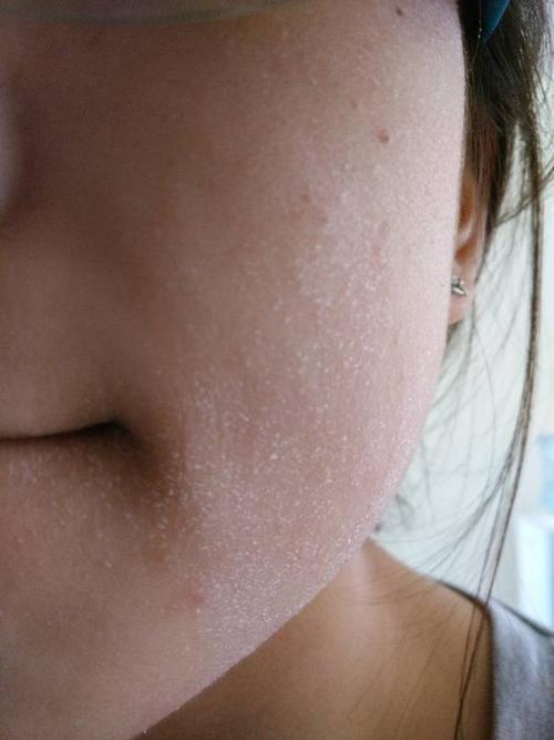 一两周了吧,之前没放在心上,但是现在脸上全是小红疙瘩,不仔细看不