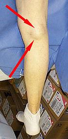 腘窝囊肿的诊治