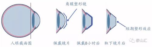 图26:角膜塑形镜原理;资料来源:wills 眼科手册