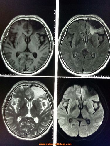 软化灶周围高信号考虑什么?