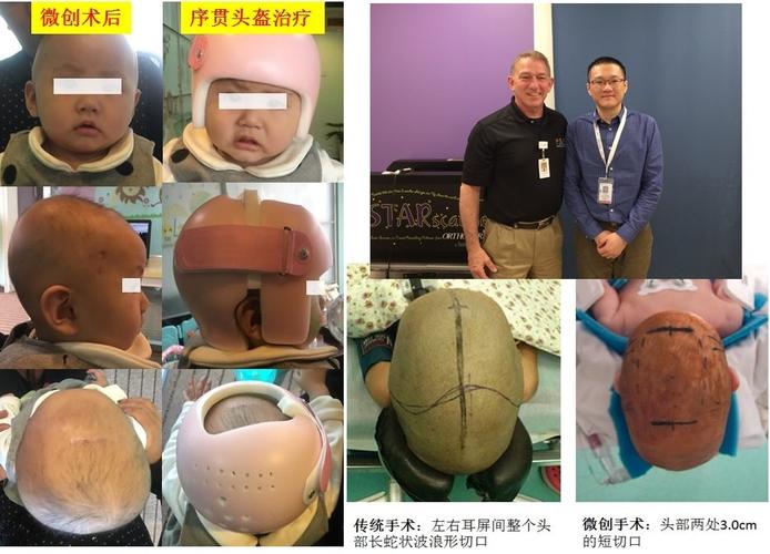 内镜 头盔 微创治疗狭颅症- 小切口,无需重建眼眶