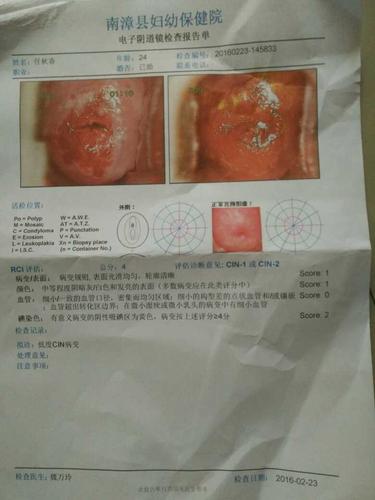 有没有懂的帮我看一下这个报告,宫颈糜烂