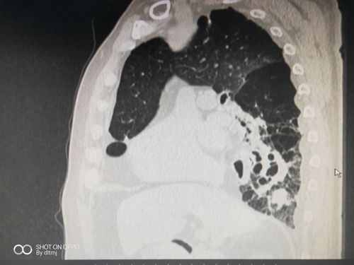 支气管扩张,自发性气胸,肺复张术后,痰液潴留,经支气管镜吸痰处理后