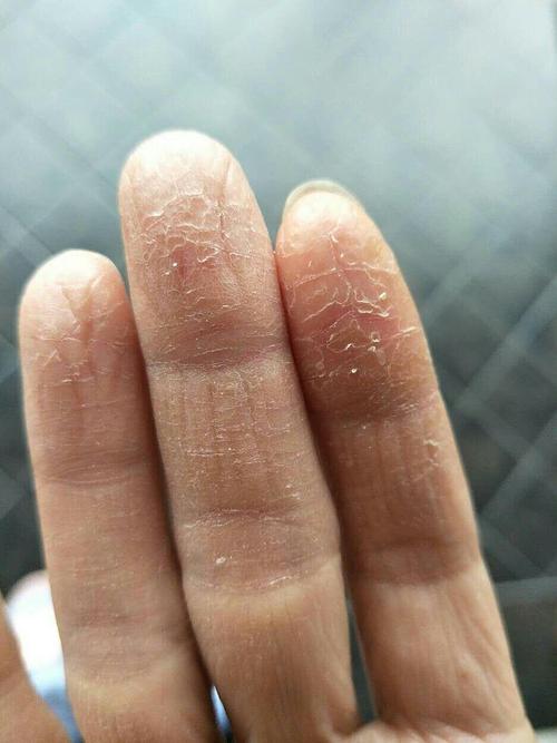 营养案例分析手指脱皮