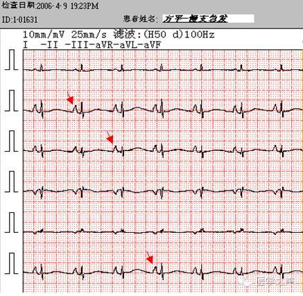 心电图课堂|第3期:右房肥大与双房肥大