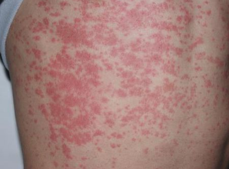 治疗真菌性皮炎湿疹的方法有哪些,中医治疗湿疹偏方大全