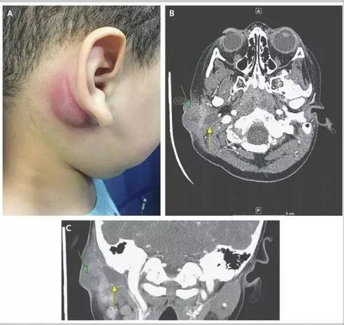 nejm:第一鳃裂囊肿案例解析