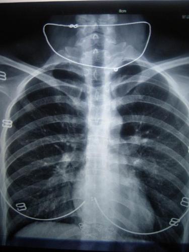 有学医的同学看下x胸片嘛!