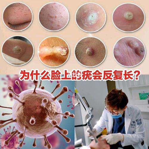 为什么脸上的疣会反复长?_皮肤问题_免疫力_扩散_医疗
