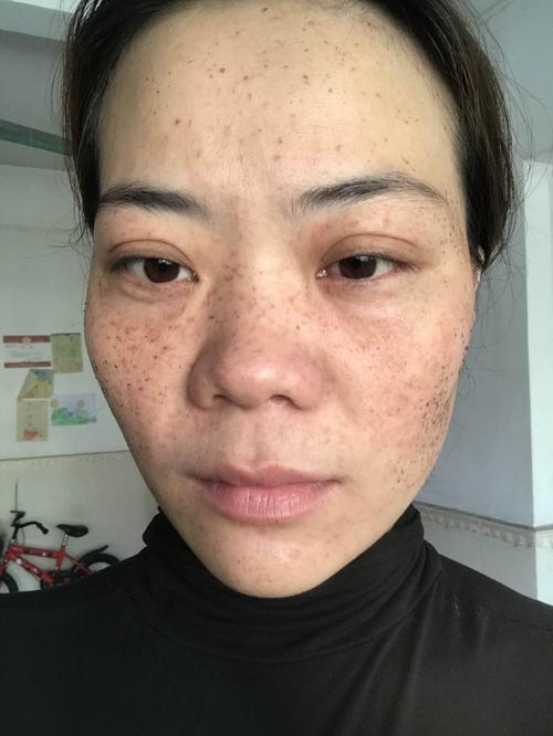 4.5雀斑 黄褐斑无创技术