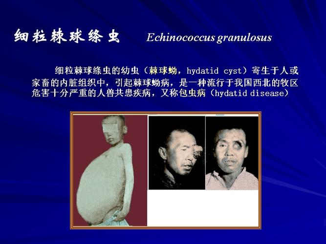 医学寄生虫学394细粒棘球绦虫.ppt