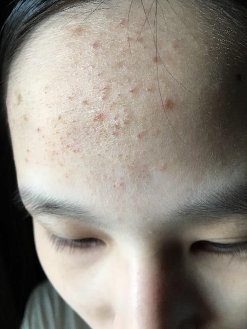 额头上这样是怎么了?突然发出来的疹子,每粒当中有红色的