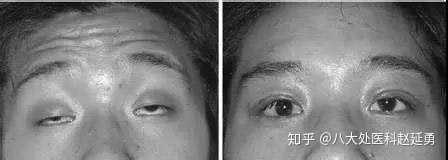 下垂(如果是重度的上睑下垂,他会遮挡视野,可能出现视物模糊,眼肌痉挛