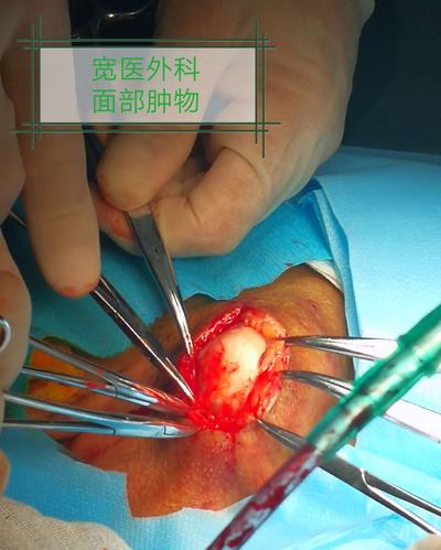 面部肿物(皮脂腺囊肿)切除