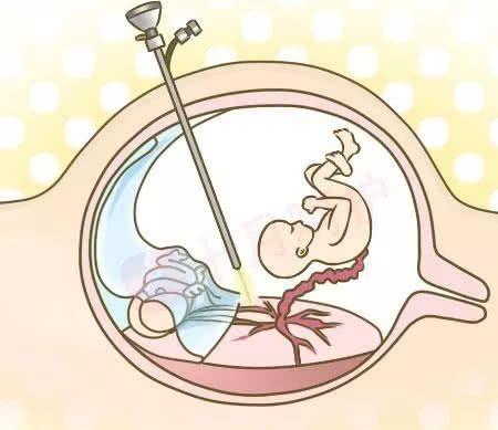 怀了双胞胎,一个"吃"掉另一个?孕妇当心危险的"双胎天敌"