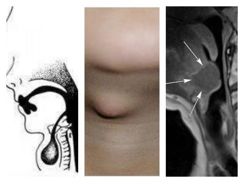 带您认识甲状舌管囊肿!