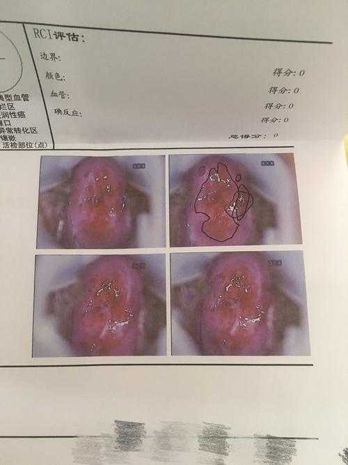 第一张图片是我做宫颈前的照片第二张是做完宫颈糜烂手术后一