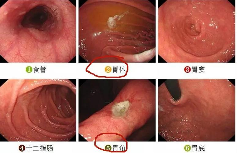 做完胃镜胃到底有没有问题教你快速看懂胃镜报告