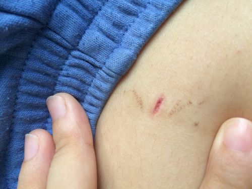 做完阑尾炎手术大半个月了,结痂今天掉了然后长成这样洗澡的时候