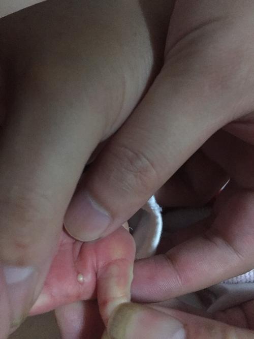 新生儿小手长了脓包,是什么原因造成的?现在该怎么办?