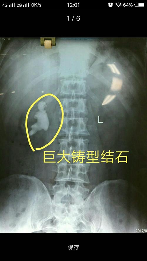 肾脏巨大铸型结石,单通道经皮肾镜碎石清石,粉碎"巨无霸"