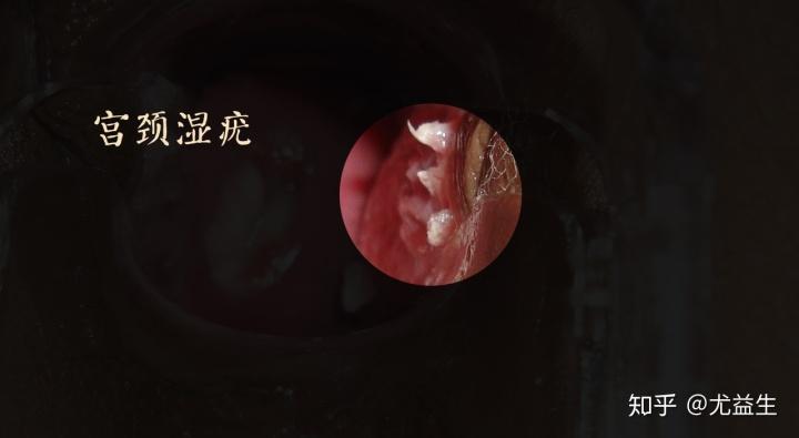 尖锐湿疣疣体表面图片慎入