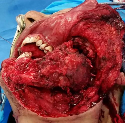 暴露下颌骨及瘤体