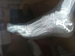 脚跟粉碎性骨折怎么办 脚后跟骨粉碎性骨折的病因有哪些