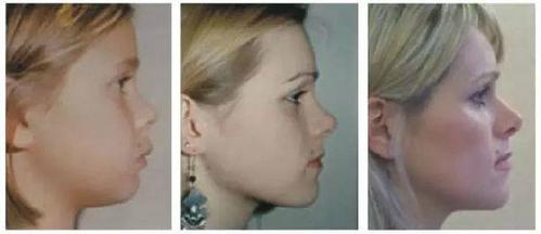 睡觉张嘴会变丑?这是真的! (转载)