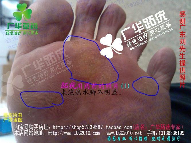 脚底很多水泡老茧鸡眼胼胝连宗瘊刺瘊甲周瘊镶嵌疣粉瘊子骨刺疣血刺泡