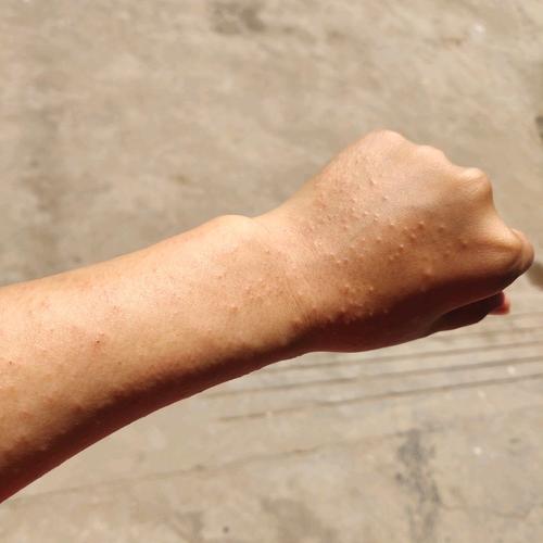 出现湿疹怎么办