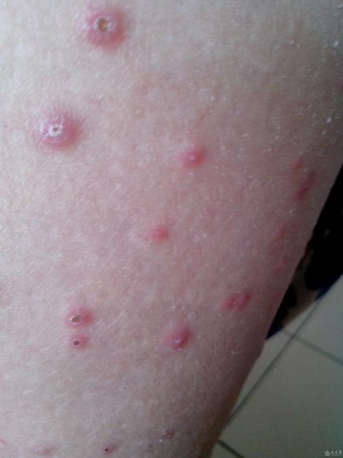 皮肤病 糖尿病10年余,血糖控制餐后10左右