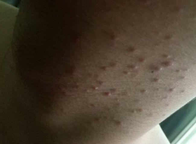 如果一个人染上了毛囊炎,可能会在脖子周围长出一些小疙瘩