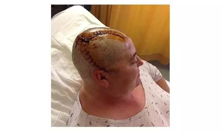 (一般的脑瘤手术)