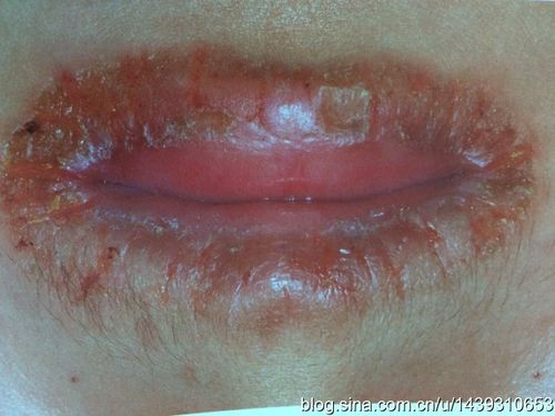 目前临床常见唇炎类型