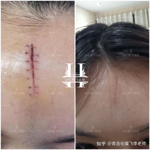 磕伤缝合疤痕修复