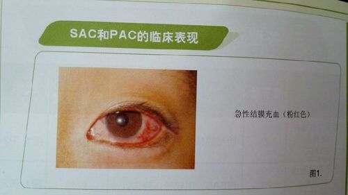 各型过敏性结膜炎特点