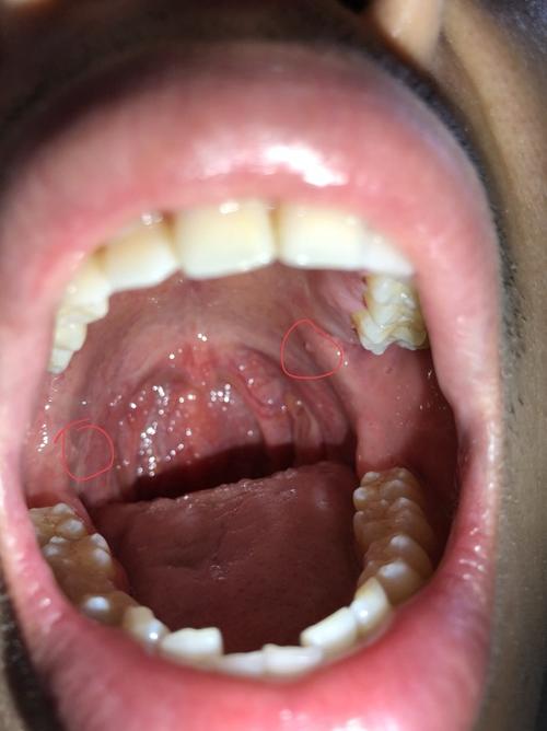 请问口腔里粘液腺囊肿是不是有必要做手术切除.一开始