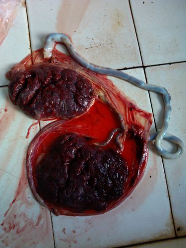 难得一见的帆状胎盘合并副胎盘